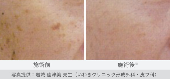 表在性色素性疾患治療（脂漏性角化症）の症例