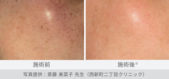 表在性色素性疾患治療（雀卵班）の症例