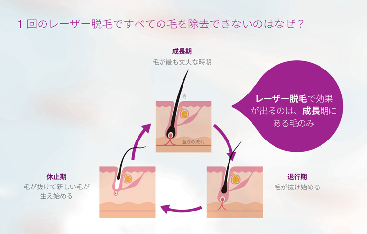 1回のレーザー脱毛ですべての毛を除去できないのはなぜ？